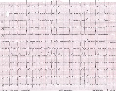 tachyarrhythmia absoluta bei vorhofflimmern